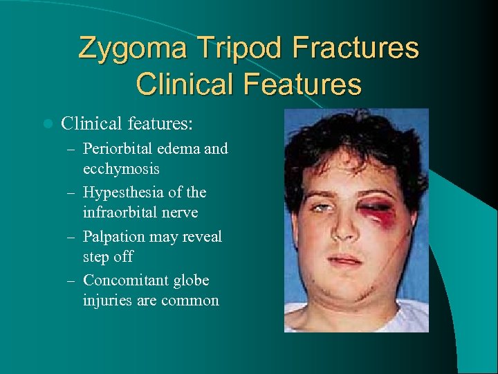 Zygoma Tripod Fractures Clinical Features l Clinical features: – Periorbital edema and ecchymosis –