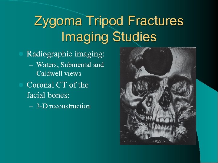 Zygoma Tripod Fractures Imaging Studies l Radiographic imaging: – Waters, Submental and Caldwell views