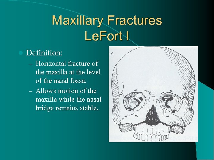 Maxillary Fractures Le. Fort I l Definition: – Horizontal fracture of the maxilla at
