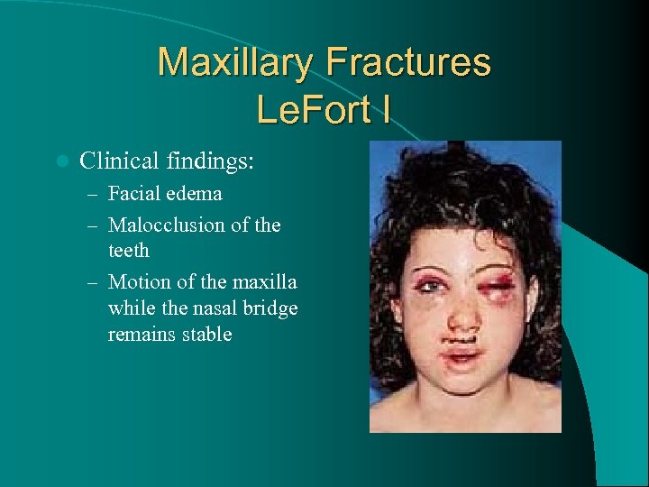 Maxillary Fractures Le. Fort I l Clinical findings: – Facial edema – Malocclusion of