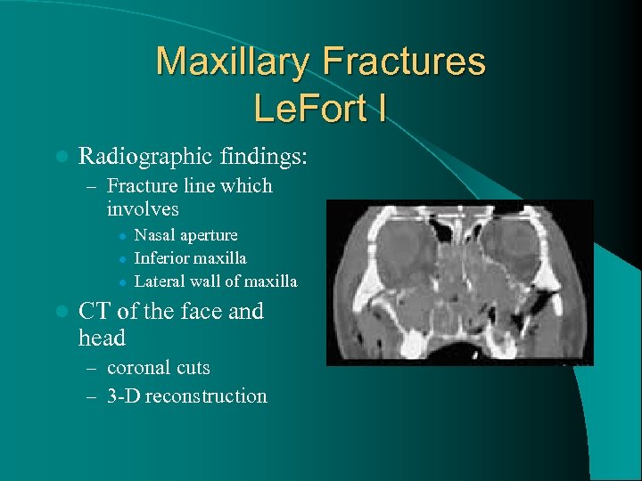 Maxillary Fractures Le. Fort I l Radiographic findings: – Fracture line which involves l