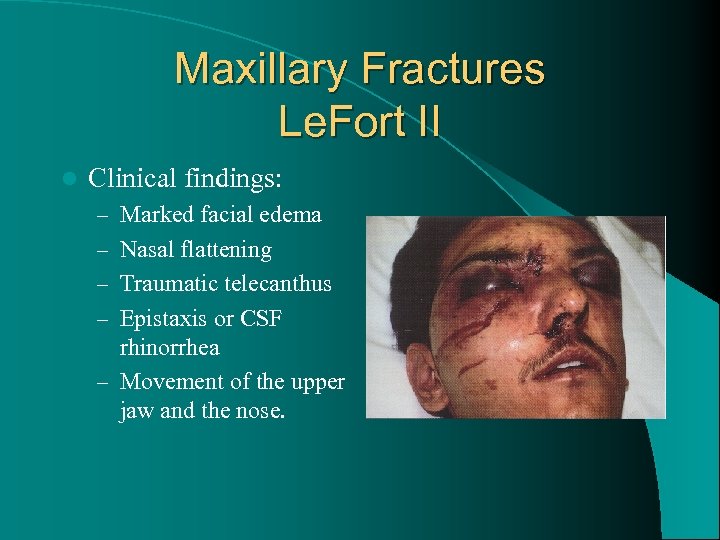Maxillary Fractures Le. Fort II l Clinical findings: – Marked facial edema – Nasal