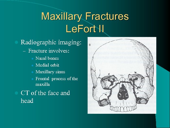 Maxillary Fractures Le. Fort II l Radiographic imaging: – Fracture involves: l l l