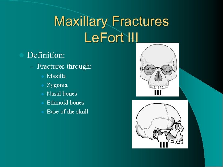 Maxillary Fractures Le. Fort III l Definition: – Fractures through: l l l Maxilla