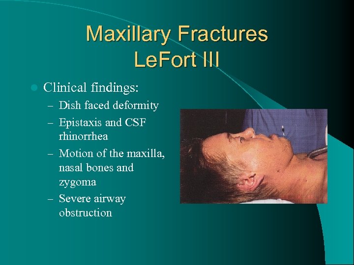 Maxillary Fractures Le. Fort III l Clinical findings: – Dish faced deformity – Epistaxis