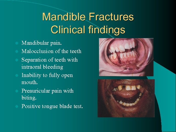 Mandible Fractures Clinical findings l l l Mandibular pain. Malocclusion of the teeth Separation