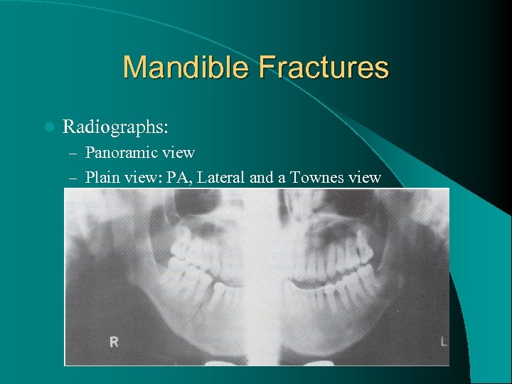 Mandible Fractures l Radiographs: – Panoramic view – Plain view: PA, Lateral and a