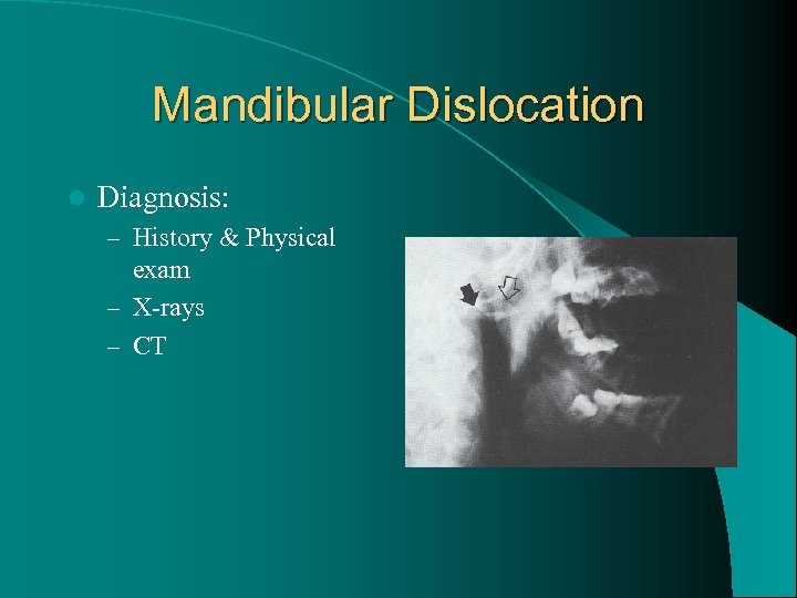 Mandibular Dislocation l Diagnosis: – History & Physical exam – X-rays – CT 