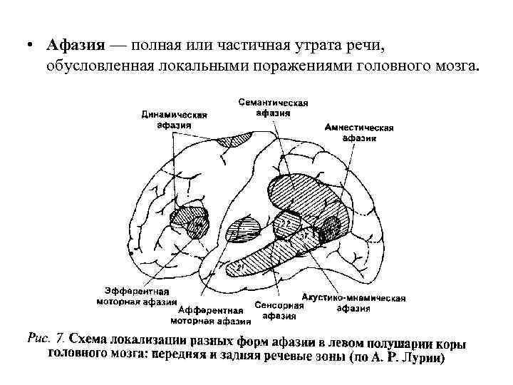  • Афазия — полная или частичная утрата речи, обусловленная локальными поражениями головного мозга.