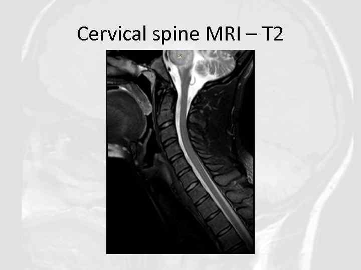 Cervical spine MRI – T 2 