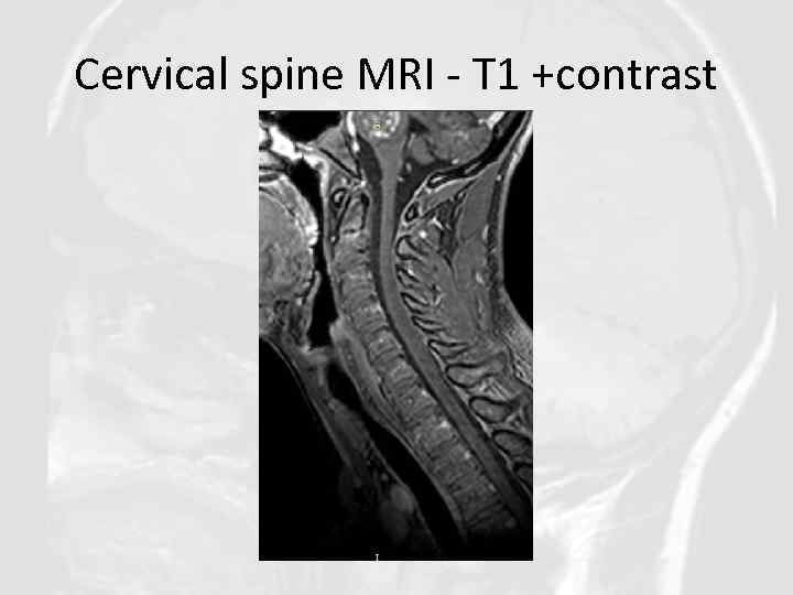 Cervical spine MRI - T 1 +contrast 