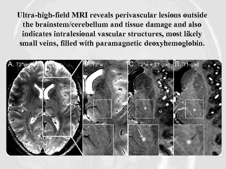 Ultra-high-field MRI reveals perivascular lesions outside the brainstem/cerebellum and tissue damage and also indicates