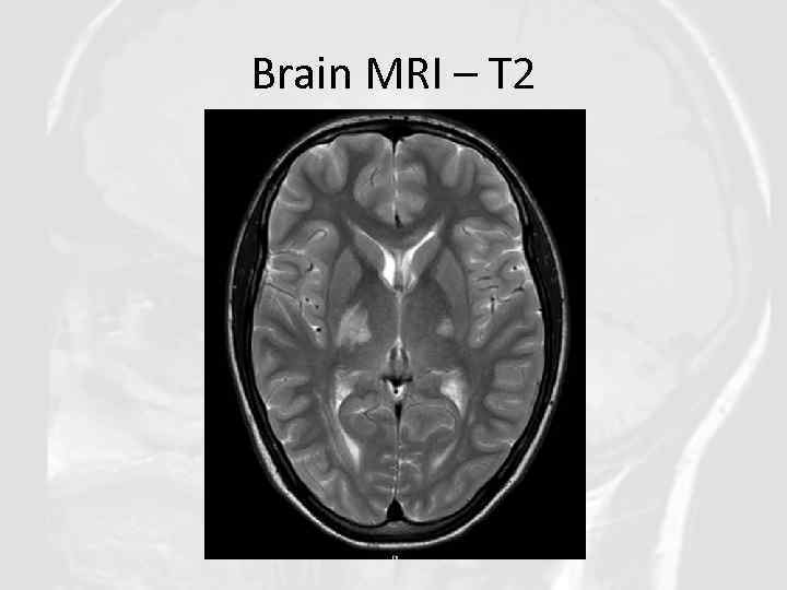 Brain MRI – T 2 