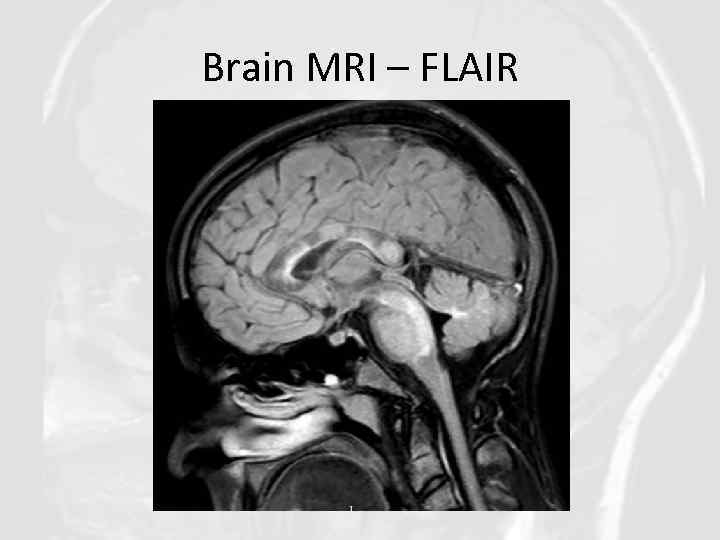 Brain MRI – FLAIR 