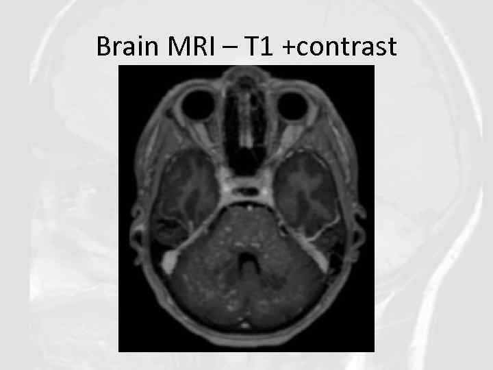 Brain MRI – T 1 +contrast 