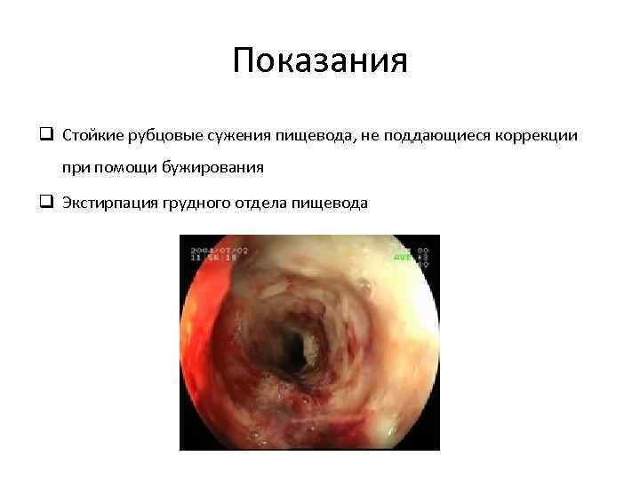Показания q Стойкие рубцовые сужения пищевода, не поддающиеся коррекции при помощи бужирования q Экстирпация