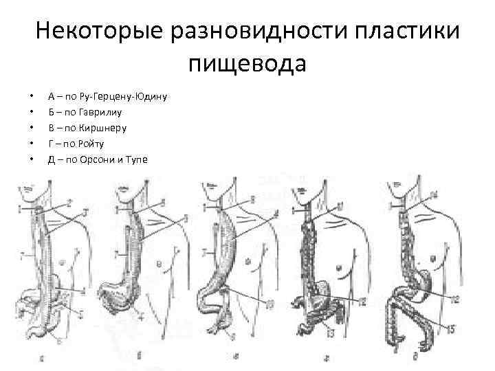 Эзофагопластика пищевода. Пластика пищевода толстой кишкой техника операции. Тонкокишечная пластика пищевода по ру. Принципы пластики пищевода Оперативная хирургия.