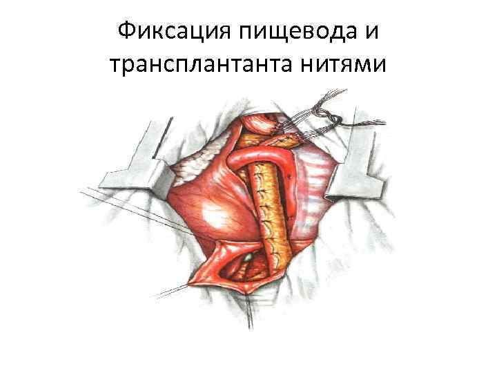 Фиксация пищевода и трансплантанта нитями 