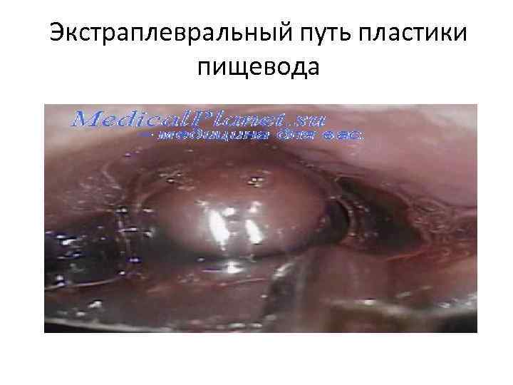 Экстраплевральный путь пластики пищевода 