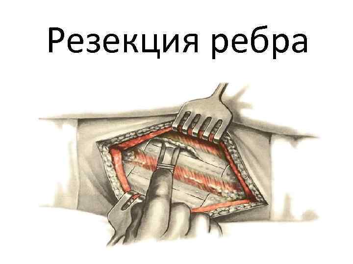 Резекция ребра 