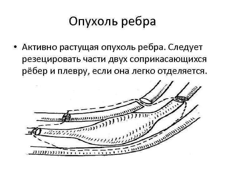 Резекция ребра презентация