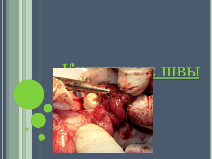 КИШЕЧНЫЕ ШВЫ 