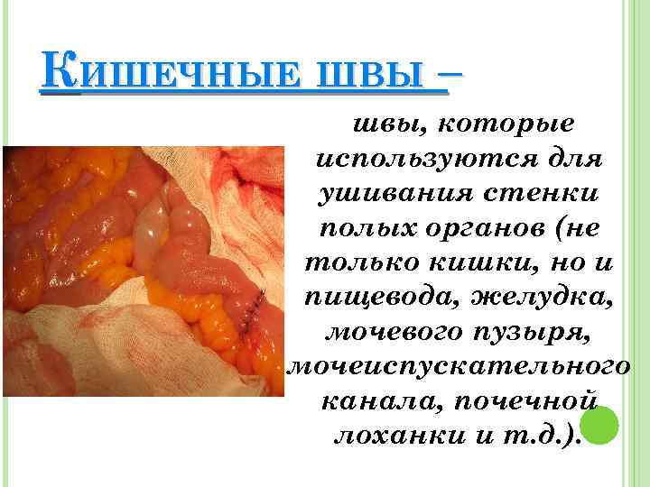 КИШЕЧНЫЕ ШВЫ – швы, которые используются для ушивания стенки полых органов (не только кишки,