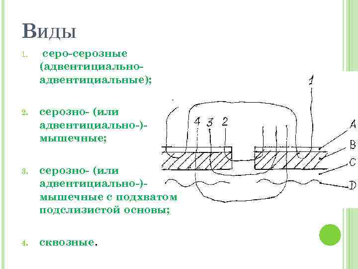 ВИДЫ 1. серо-серозные (адвентициальноадвентициальные); 2. серозно- (или адвентициально-)мышечные; 3. серозно- (или адвентициально-)мышечные с подхватом