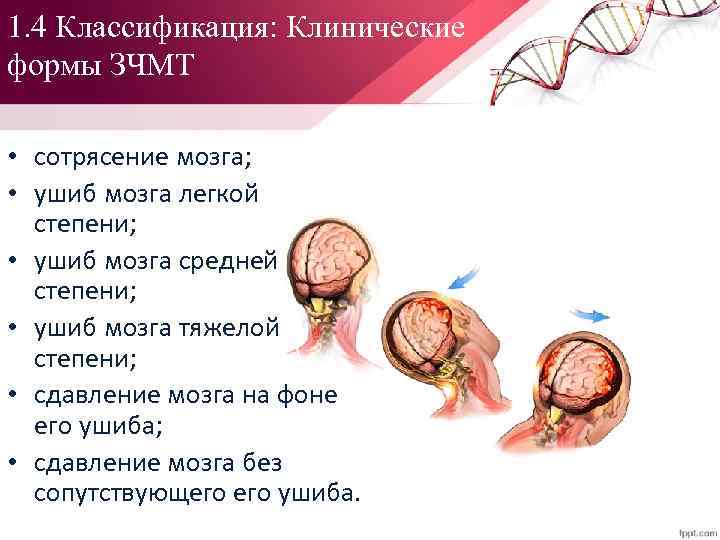 1. 4 Классификация: Клинические формы ЗЧМТ • сотрясение мозга; • ушиб мозга легкой степени;