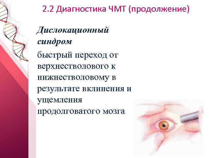 2. 2 Диагностика ЧМТ (продолжение) Дислокационный синдром быстрый переход от верхнестволового к нижнестволовому в