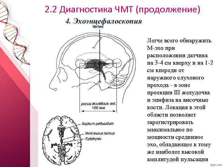 2. 2 Диагностика ЧМТ (продолжение) 4. Эхоэнцефалоскопия Легче всего обнаружить М эхо при расположении