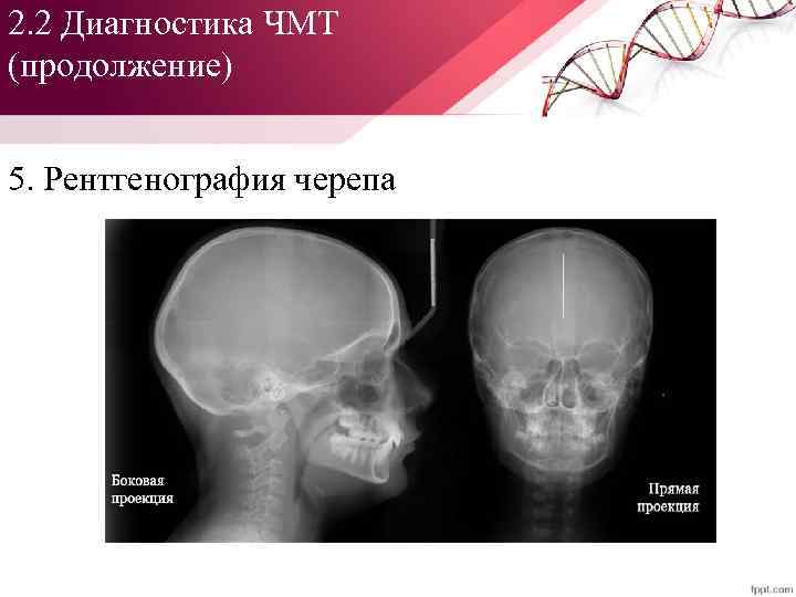 2. 2 Диагностика ЧМТ (продолжение) 5. Рентгенография черепа 