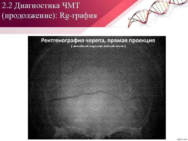 2. 2 Диагностика ЧМТ (продолжение): Rg графия 