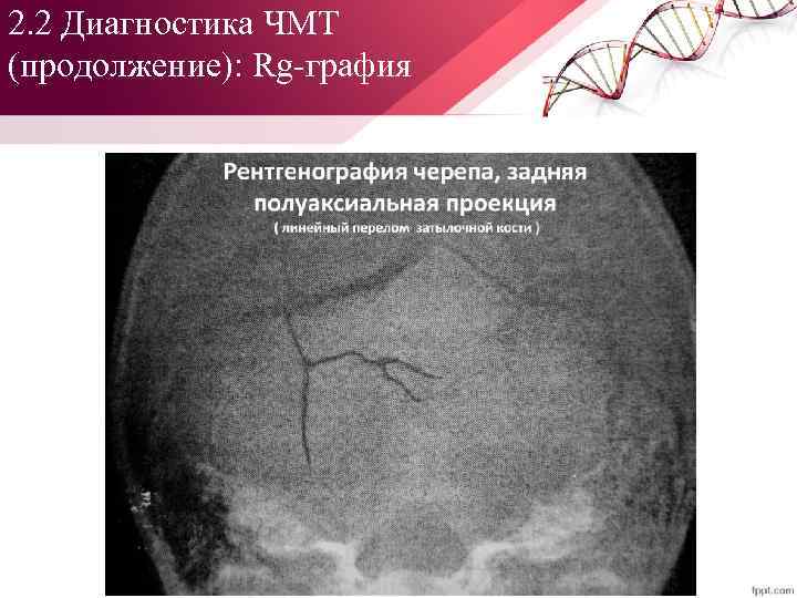 2. 2 Диагностика ЧМТ (продолжение): Rg графия 