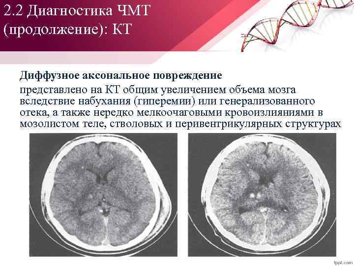 2. 2 Диагностика ЧМТ (продолжение): КТ Диффузное аксональное повреждение представлено на КТ общим увеличением