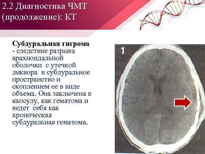 2. 2 Диагностика ЧМТ (продолжение): КТ Субдуральная гигрома следствие разрыва арахноидальной оболочки с утечкой