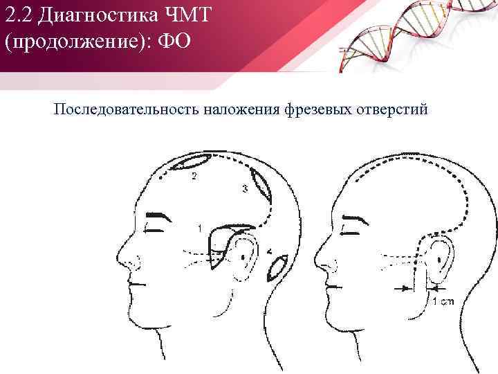 2. 2 Диагностика ЧМТ (продолжение): ФО Последовательность наложения фрезевых отверстий 