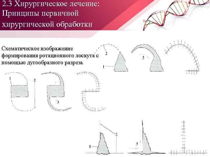 2. 3 Хирургическое лечение: Принципы первичной хирургической обработки. Схематическое изображение формирования ротационного лоскута с