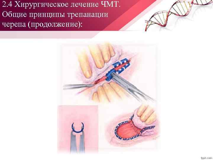 2. 4 Хирургическое лечение ЧМТ. Общие принципы трепанации черепа (продолжение): 