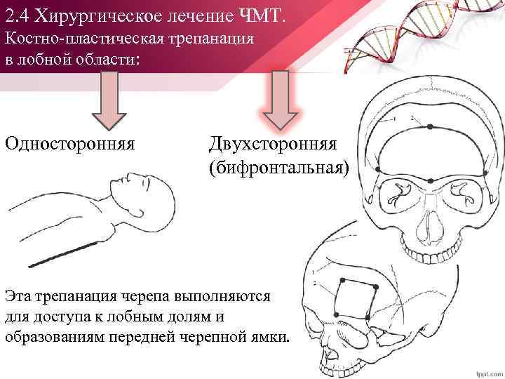 2. 4 Хирургическое лечение ЧМТ. Костно пластическая трепанация в лобной области: Односторонняя Двухсторонняя (бифронтальная)