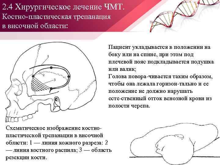 2. 4 Хирургическое лечение ЧМТ. Костно пластическая трепанация в височной области: Пациент укладывается в