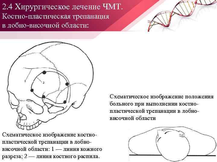 2. 4 Хирургическое лечение ЧМТ. Костно пластическая трепанация в лобно височной области: Схематическое изображение