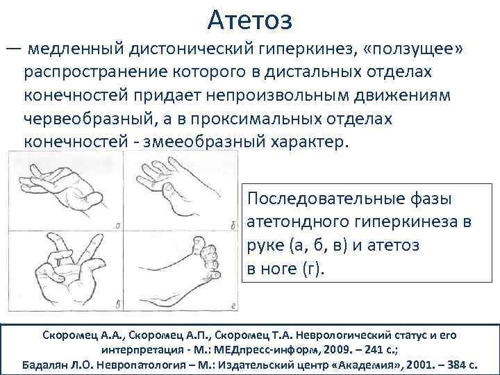 Дистонический тип рэг на фоне достаточного симметричного кровенаполнения