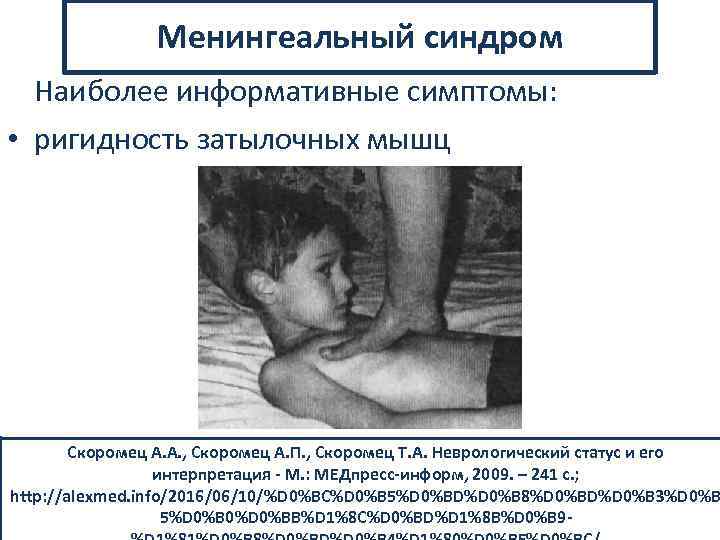 Менингеальный синдром Наиболее информативные симптомы: • ригидность затылочных мышц Скоромец А. А. , Скоромец