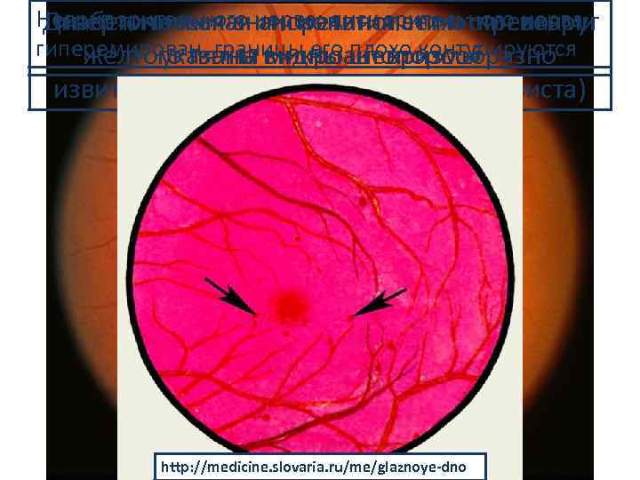 Неврит зрительного нерва: диск зрительного нерва Диабетическая ангиоретинопатия: стрелками Гипертоническая ангиопатия сетчатки: вокруг гиперемирован,