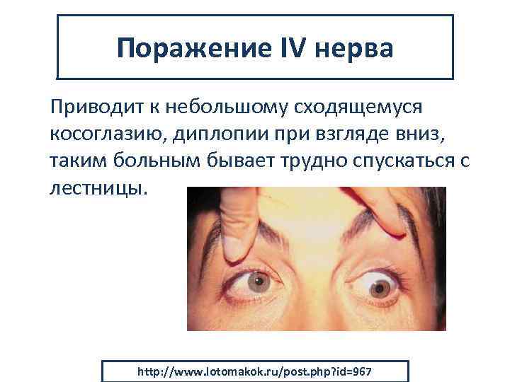 Поражение IV нерва Приводит к небольшому сходящемуся косоглазию, диплопии при взгляде вниз, таким больным