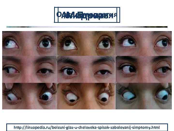Офтальмоплегия Анизокория Мидриаз Птоз http: //linzopedia. ru/bolezni-glaz-u-cheloveka-spisok-zabolevanij-simptomy. html https: //moiglaza. com/bolezni/midriaz/rasshirennyj-zrachok https: //tr. instela.