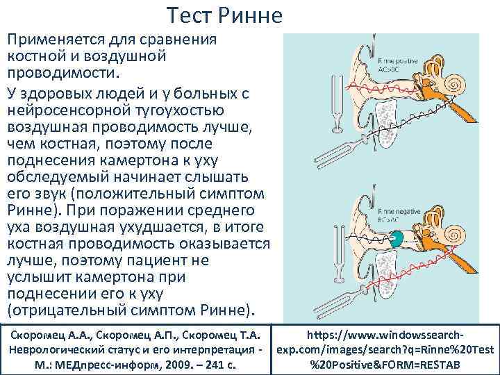 Тест Ринне Применяется для сравнения костной и воздушной проводимости. У здоровых людей и у