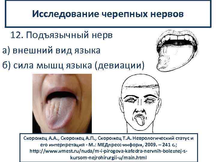 Исследование черепных нервов 12. Подъязычный нерв а) внешний вид языка б) сила мышц языка