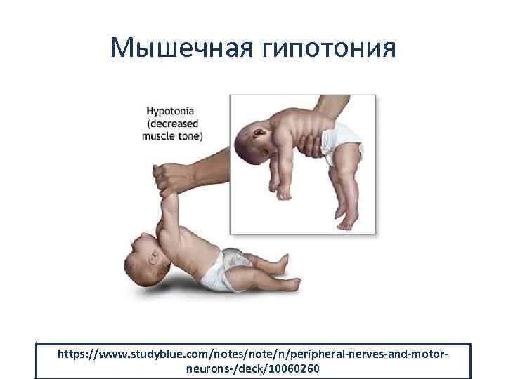 Мышечная гипотония https: //www. studyblue. com/notes/note/n/peripheral-nerves-and-motorneurons-/deck/10060260 